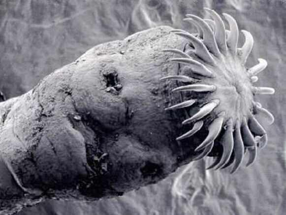 parasitärer Wurm aus dem menschlichen Körper