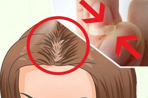Probleme mit Haaren und Nägeln aufgrund von Parasiten
